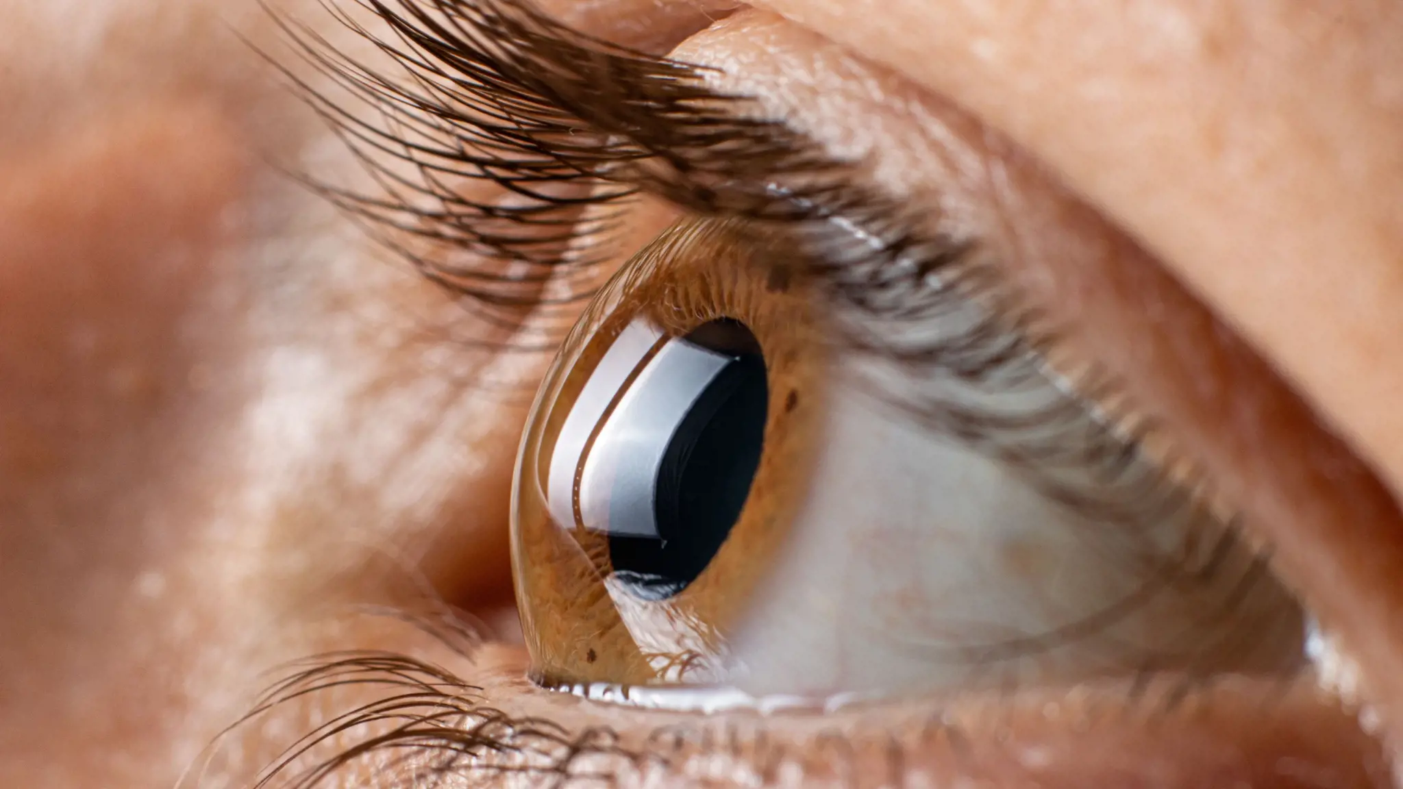 Viêm thị thần kinh và những điều cần biết