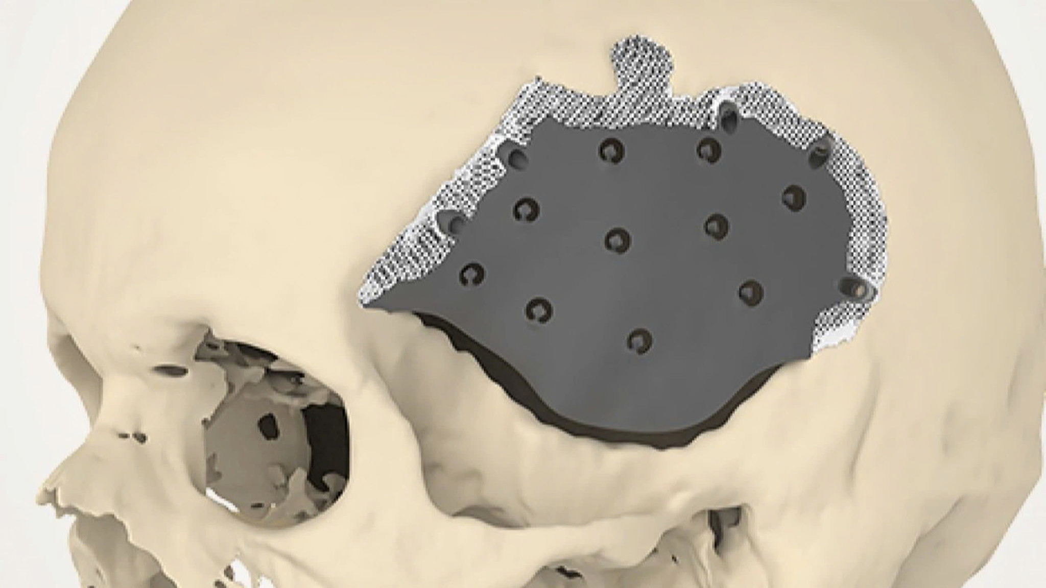 Tiêu xương sọ: Bệnh lý hiếm gặp và khó phát hiện