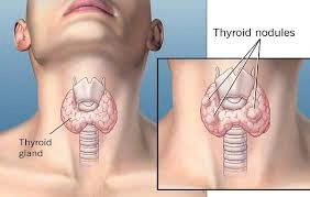 Bướu giáp nhân là gì? Nguyên nhân, triệu chứng và cách điều trị