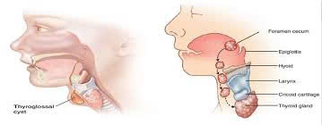 U nang giáp móng là gì? Nguyên nhân, triệu chứng và cách điều trị