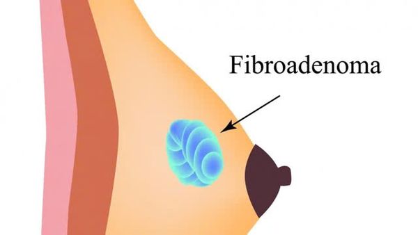 Bướu sợi tuyến BI-RADS 3 là gì? Nguyên nhân và cách điều trị bướu sợi tuyến BI-RADS 3