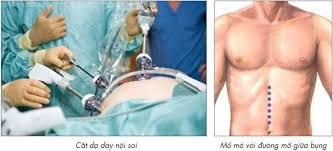 Có nên phẫu thuật ung thư dạ dày? Phẫu thuật sống được bao lâu?