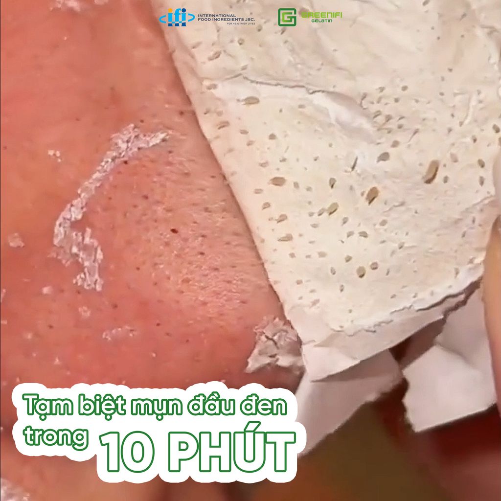 TẠM BIỆT MỤN CÁM, MỤN ĐẦU ĐEN NGAY TẠI NHÀ! CHỈ 10 PHÚT, BẠN BIẾT CHƯA!?!