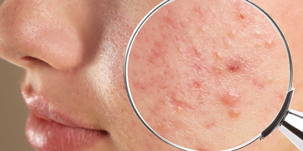 5 Bước Chăm Da Mụn Hiệu Quả Để Cải Thiện Tình Trạng Da