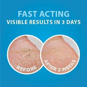 Liệu pháp da Heel Magic