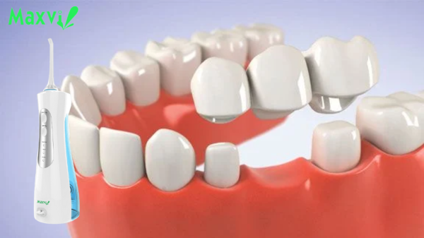 Người làm răng giả sử dụng tăm nước có lợi hay hại?