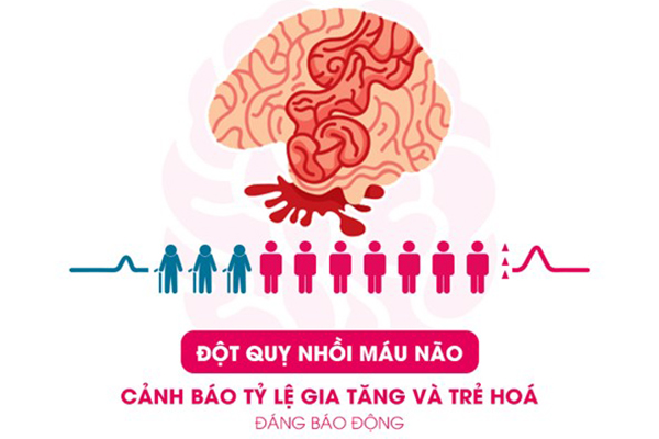 Người trẻ hiện tăng cao nguy cơ bị Đột Quỵ