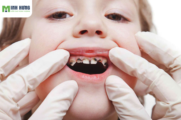 mach-ban-cach-cham-soc-rang-mieng-cho-tre-dung-cach