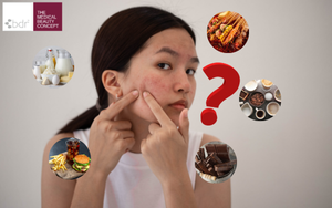 Nên Kiêng Ăn Gì Khi Bị Mụn? Giải Đáp Toàn Diện Và Bí Quyết Làn Da Sáng Khỏe