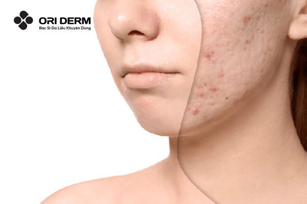 Sẹo Mụn Có Tự Hết Không? 5 Cách Cải Thiện Sẹo Mụn Hiệu Quả