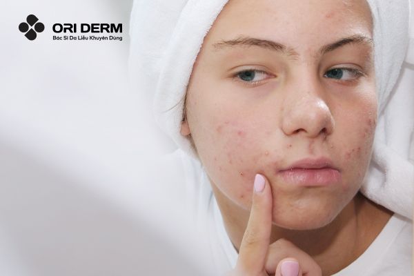 Triệu chứng nhận biết mụn nội tiết