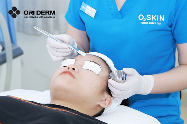 Peel da điều trị mụn ẩn trên trán