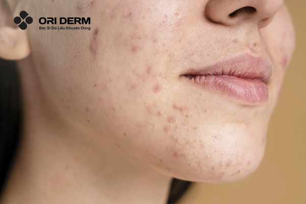 Loại da nào phù hợp với Vitamin C?