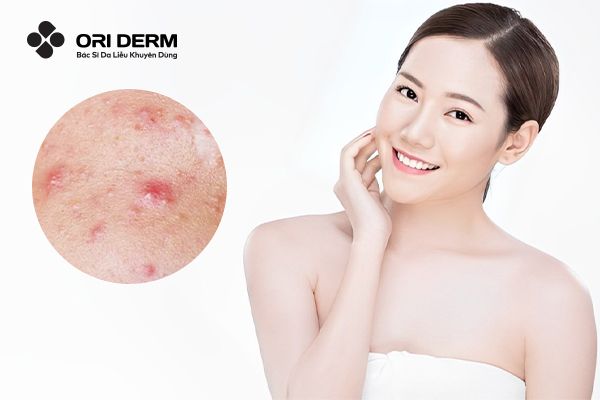 10 Cách Trị Mụn Viêm Đỏ Ở Má Hiệu Quả Cho Da Láng Mịn Hơn