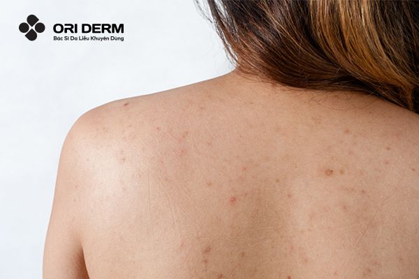Mụn lưng là gì? Các tác hại do mụn lưng gây ra