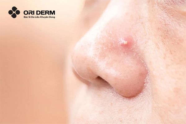 Cồi mụn là gì? Nguyên nhân hình thành cồi mụn?