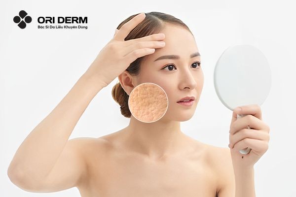 Sẹo Rỗ Là Gì? Nguyên Nhân, Phân Loại Và Phương Pháp Điều Trị