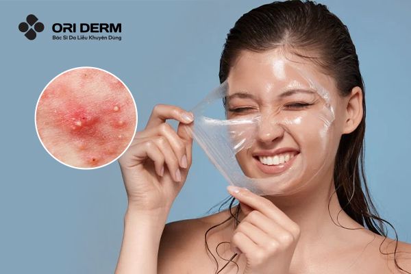 Bị Mụn Viêm Có Nên Peel Da Không? Những Lưu Ý Cần Nắm Trước Khi Peel