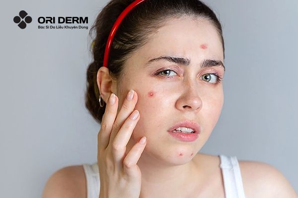 Mụn Viêm Bị Vỡ: Nguyên Nhân Và Cách Xử Lý An Toàn, Không Để Lại Sẹo