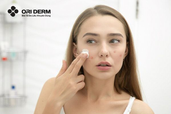 Có nên xử lý mụn viêm tại nhà hay không?