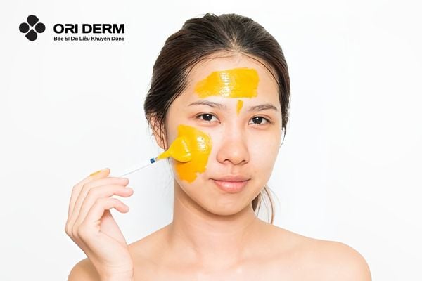 10 Cách Trị Thâm Mụn Bằng Nghệ Tươi Hiệu Quả, Tiết Kiệm