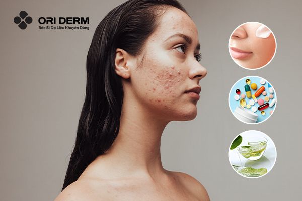 Bật Mí 23 Cách Trị Mụn Hiệu Quả Tại Nhà Cho Da Láng Mịn Tự Nhiên