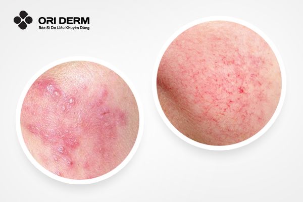 Dấu hiệu nhận biết da nhiễm Corticoid