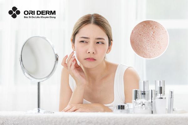 Sẹo Rỗ Đáy Nhọn Là Gì? Nguyên Nhân Và Phương Pháp Cải thiện