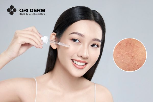 Retinol Trị Mụn Ẩn Hiệu Quả Không? Nhưng Lưu Ý Khi Dùng