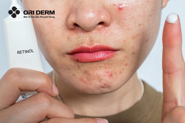 Retinol Là Gì? Công Dụng Của Retinol Trong Làm Đẹp Da Mặt