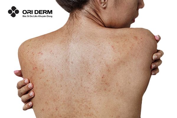 Vì sao cần phải tẩy tế bào chết body