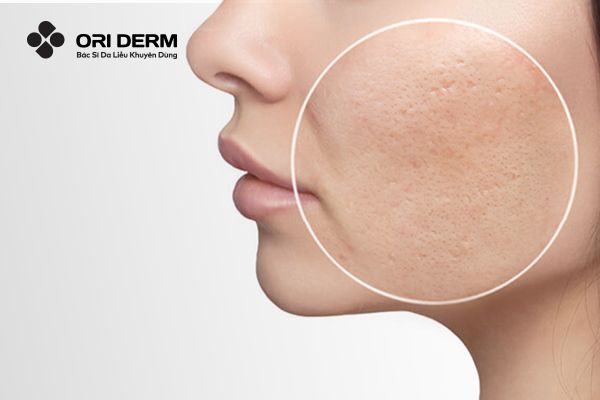 Tổng Hợp Các Phương Pháp Trị Sẹo Rỗ Hiệu Quả Hiện Nay