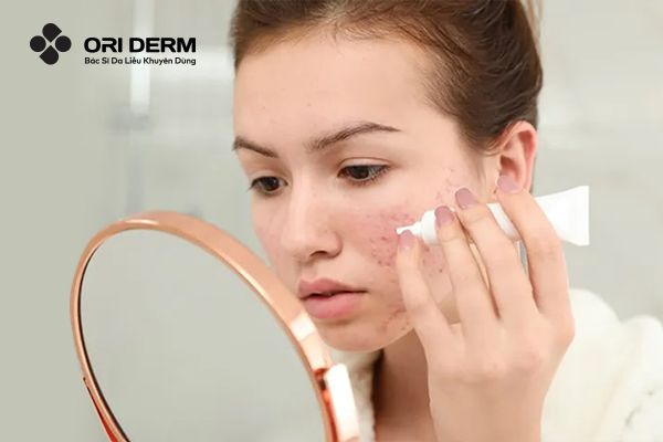 Dùng thuốc/kem/serum đặc trị bôi ngoài da