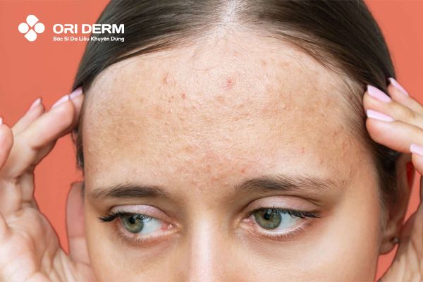 Tại sao trán là vùng da dễ bị mụn ẩn?