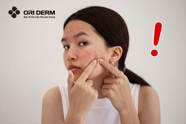 Những lưu ý khi trị mụn viêm dưới da mà bạn cần biết