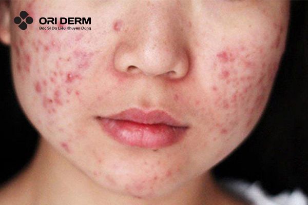 Mụn viêm ở má và những dấu hiệu nhận biết