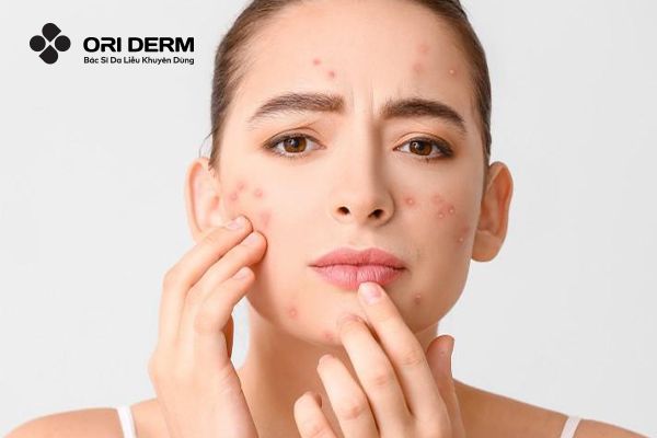 Mụn Viêm Mủ Là Gì? Nguyên Nhân Và Cách Xử Lý Hiệu Quả