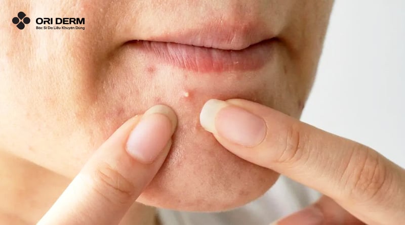 Điều trị mụn đầu trắng