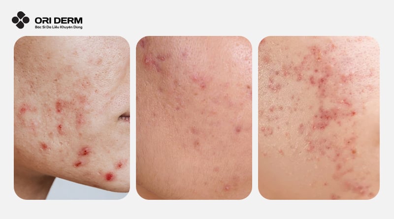 Phục hồi da mụn