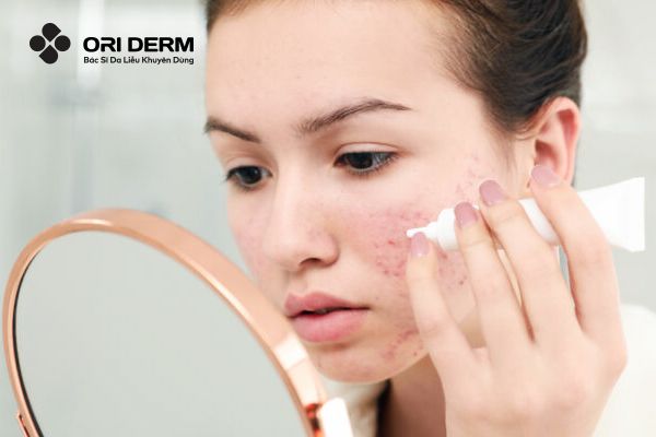 Thoa sản phẩm đặc trị mụn (serum, thuốc bôi trị mụn…)