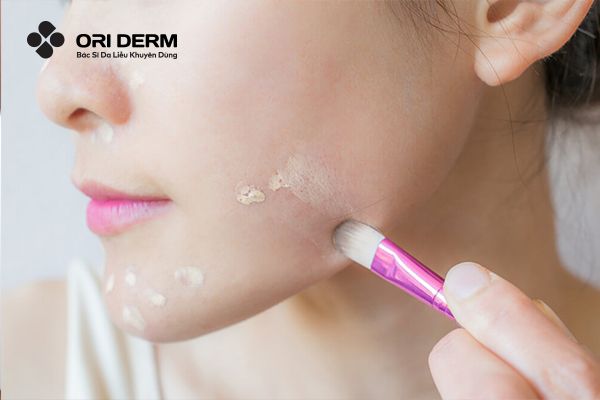 Sử dụng kem che khuyết điểm (concealer) che mụn