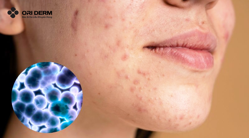 Hình ảnh mụn hỗn hợp