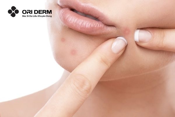 Khi dùng bha bị đẩy mụn có nên nặn không?