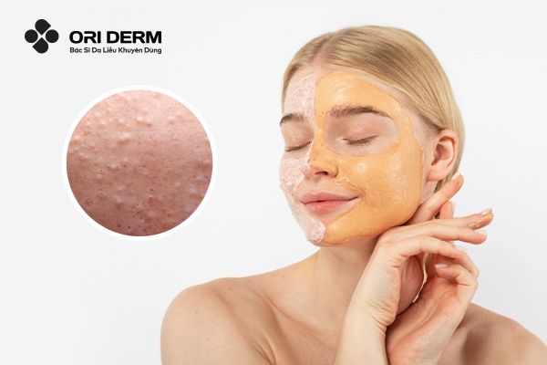 Bật Mí 13 Cách Trị Mụn Ẩn An Toàn Và Hiệu Quả, Dễ Áp Dụng Tại Nhà