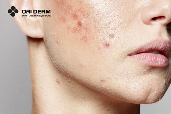 Da hỗn hợp thiên dầu mụn là gì?