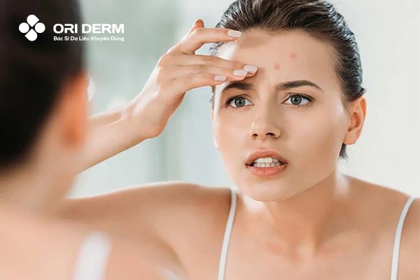 Nổi Mụn Viêm Ở Trán Nguyên Nhân Do Đâu? Cách Xử Lý Mụn Viêm Nhanh Gọn