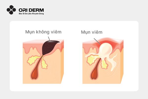 Cách phân biệt các loại mụn viêm và mụn không viêm