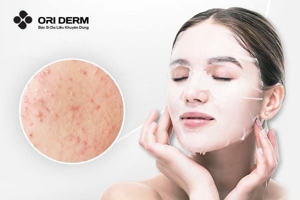 10 Loại Mặt Nạ Trị Mụn Hiệu Quả Và An Toàn Cho Da, Dễ Sử Dụng Tại Nhà