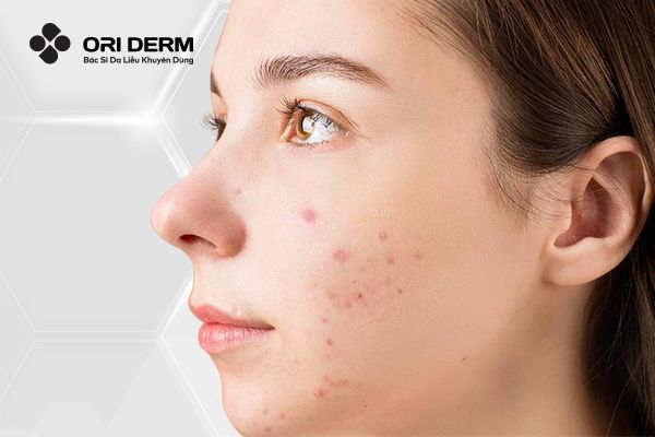 Hướng Dẫn Cách Gom Cồi Mụn Nhanh Chóng Và Hiệu Quả Tại Nhà