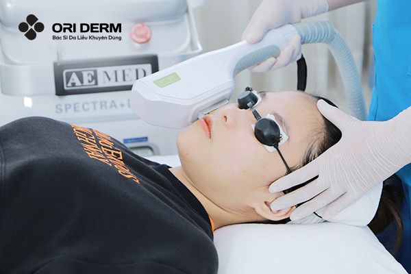 Tiêu diệt các ổ mụn viêm bằng phương pháp IPL